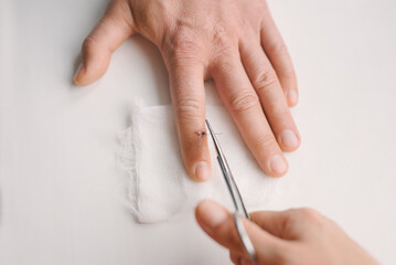 Removal of suture on finger of patient in clinic. Inspection of seam on finger after removal of...