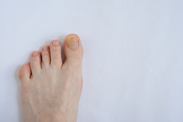 Toenails affected by fungal infection. Onychomycosis - obrazy, fototapety, plakaty