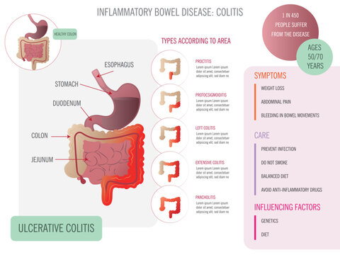 Infographic about ulcerative colitis types, symptoms, care with corresponding icons on white background