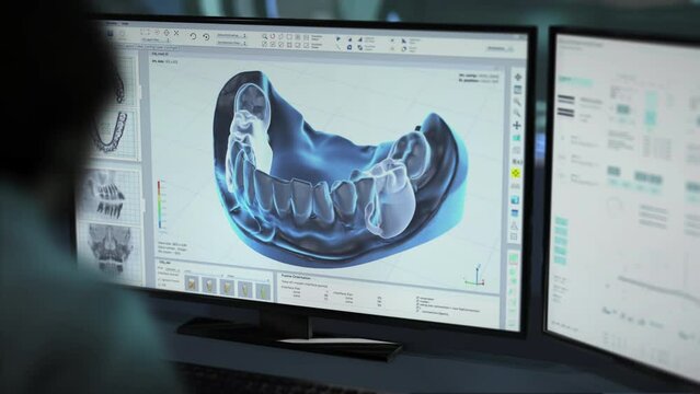 Using medical software to visualise the artificial teeth insertion into the jaw model. Putting the new replacement teeth into the jaw model. Fixing the damaged jaw model with teeth restorations.