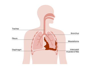 Mesothelioma cancer disease