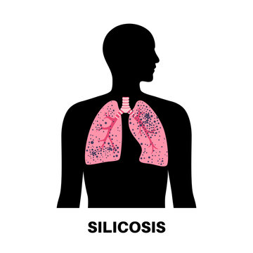 Silicosis dust in lung