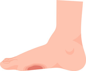 Foot Ulcer Disease