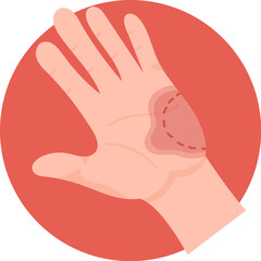 Bite On Hand Symptom