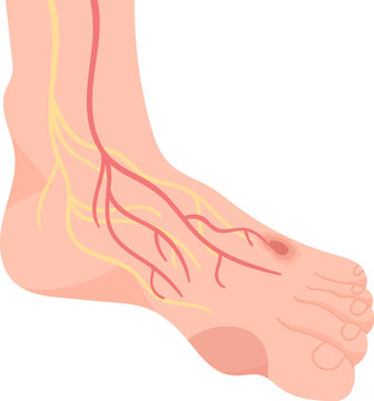 Human Foot Diseases