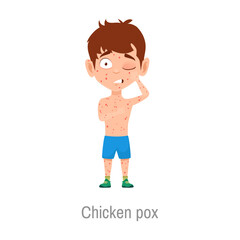 Chicken pox kid sickness, isolated vector sick boy with varicella, highly contagious disease caused by the initial infection with varicella zoster virus. Child with rash and red scratchy spots on body