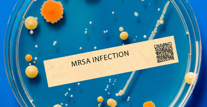 MRSA infection - Bacterial infection that is resistant to many