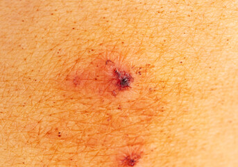 Ringworm on human skin as a background. Macro.