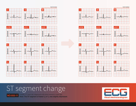 Female, 57 years old, diagnosed with mitral stenosis 6 years ago. Two outpatient electrocardiograms in 2010 showed left atrial abnormality and ST segment  changes.