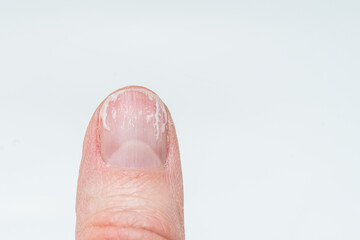woman's finger with bitten and broken nails without manicure with overgrown cuticle and a damaged nail plate - obrazy, fototapety, plakaty