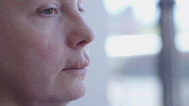 herpes on female lips. woman face portrait with infection virus on mouth herpes simplex inflammation symptom condition. herpetic pimple close-up on girl oral. concept of health and care