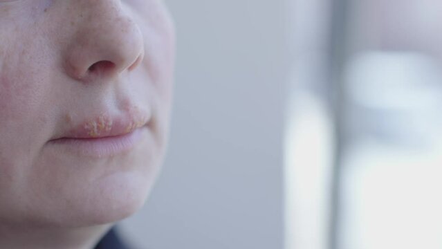 herpes on female lips. woman face portrait with infection virus on mouth herpes simplex inflammation symptom condition. herpetic pimple close-up on girl oral. concept of health and care