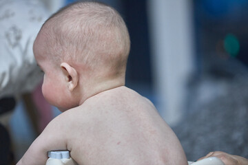 roseola rash a viral rash on the skin of a child