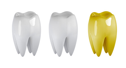 Molar teeth implant, bridge or veneer treatment for missing tooth surgery restoration. Artificial prosthesis or oral crown as row gap filling.