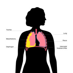 Mesothelioma cancer disease