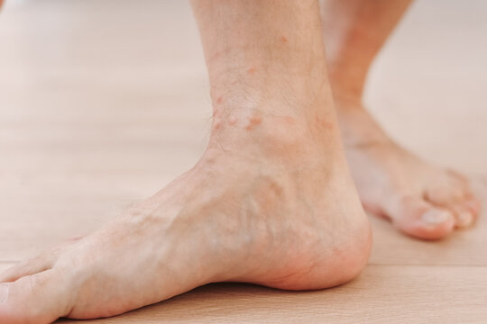Close up allergic rash dermatitis eczema on man foot. Leg with red rash caused by insect bites. Dermatitis, folliculitis, fungal infection. Affected area of skin to turn red and blotchy and to swell