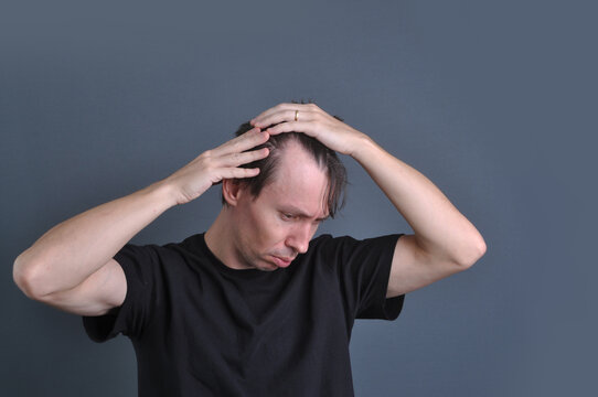 homem com problema de calvicie express&atilde;o triste 