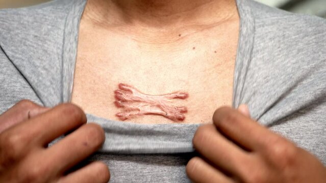 Male hand opening t-shirt showing chest scar