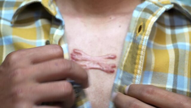 Man's hand unbuttoning his shirt showing a scar on his chest