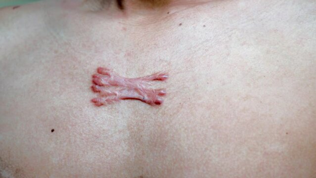 Thick scars on Asian men's chest