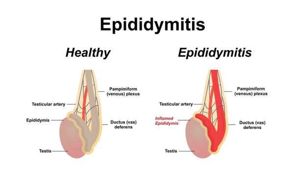 Epididymitis is inflammation of the epididymis of the testicle.