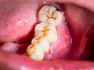Poor oral and dental health, cavities, gum disease and swollen gums can lead to toothache. The...