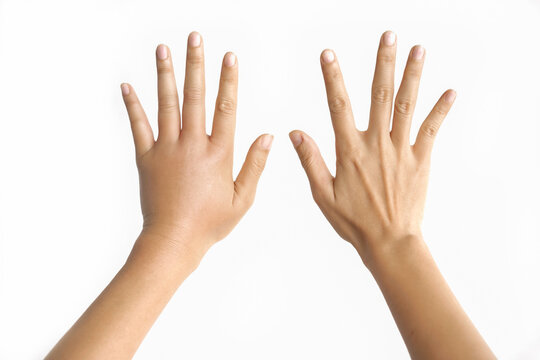 Close-up comparison of woman's hand swollen from insect bites on white background. Top view of swollen and inflamed hand from insect sting isolated on white background