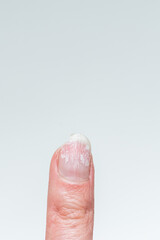 A woman's finger with bitten and broken nails without manicure with an overgrown cuticle and a...