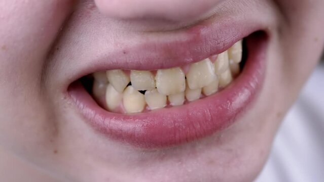 Close up, Wide Smile of a Teenager with Straight, Even Teeth and Plaque. Body part. Portrait. Close-up of lips. Boy with problem skin and pimples shows a toothy smile. Dentistry. Oral hygiene concept.