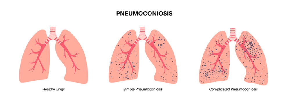 Pneumoconiosis lung disease