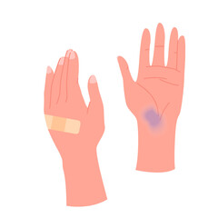 Obraz premium Human hands with band aid, bruise on palm, infographic vector illustration. Cartoon isolated two broken hands after injury or accident damage, medical adhesive tape for treatment of cut on arms skin