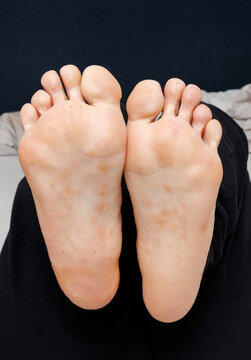 Dyshidrotic eczema on the sole of female feet