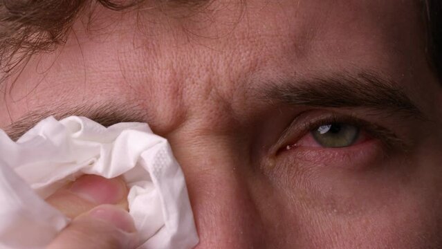 Man pats down eye with tissue to remove puss from eye infection - pink eye - close up on face