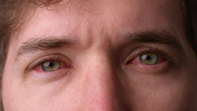 Man with pink eye in both eyes does a long painful blink - close up on eyes