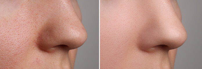Before and after acne treatment. Photos of woman on grey background, closeup. Collage showing...