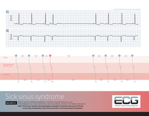 When sinoatrial node pacemaker cells are dysfunctional, one atrial premature contraction can significantly inhibit the function of sinoatrial node, resulting in a long PP interval.