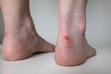 Fototapeta premium Young woman's bruised ankle from uncomfortable shoes. Open wound on the spur, peeling skin, close up macro shot, unrecognizable face