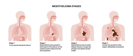 Mesothelioma cancer stages