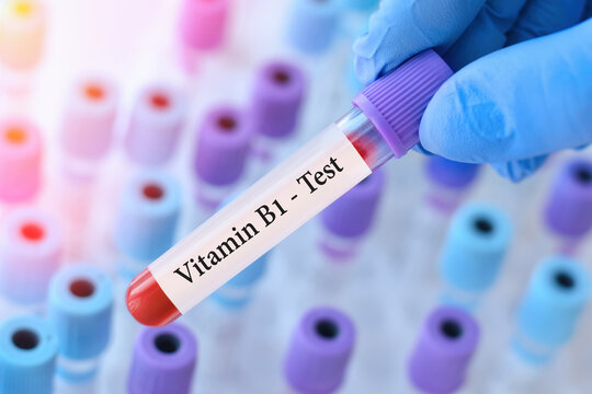 Doctor holding a test blood sample tube with Vitamin B1 test on the background of medical test tubes with analyzes.Banner.Copy space for text