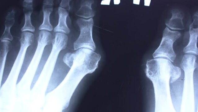 Doctor hands with blue medical x ray scan of feet and toes with Hallux Valgus deformity close up