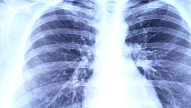 Blue medical x ray of chest scan on light background. Covid desease, cancer examination, pneumonia, asthma and tuberculosis diagnostic concept