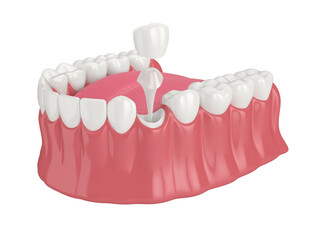 3d render of lower jaw with post and core tooth restoration