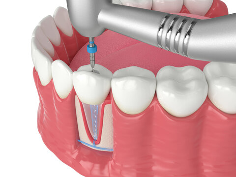 3d render of lower jaw with handpiece and endodontic rotary file over white background
