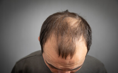Caucasian man. Hair loss problem