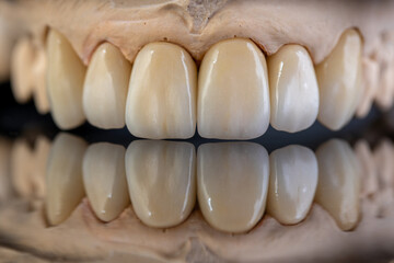 Dental health care. Ceramic zirconium in final version. Close up dental zircon ceramic crowns on...