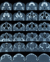 MRT scan of head