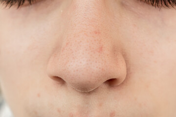the face of a teenage boy with acne and acne. red rashes on the skin. proper care and treatment of inflammation on the skin. hygiene of facial care. cosmetology medicine for teenagers.