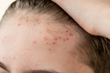 Obraz premium the face of a teenage boy with acne and acne. red rashes on the skin. proper care and treatment of inflammation on the skin. hygiene of facial care. cosmetology medicine for teenagers.