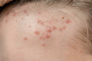 the face of a teenage boy with acne and acne. red rashes on the skin. proper care and treatment of inflammation on the skin. hygiene of facial care. cosmetology medicine for teenagers.