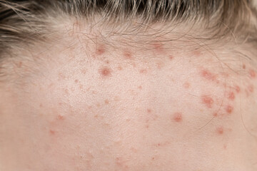 the face of a teenage boy with acne and acne. red rashes on the skin. proper care and treatment of...